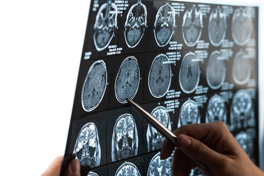 Beyin tümörleri: Türleri, belirtileri, teşhis yöntemleri ve tedavi seçenekleri